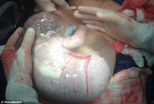 Khoảnh khắc cực hiếm: Em bé chào đời vẫn nằm trong túi nước ối 1