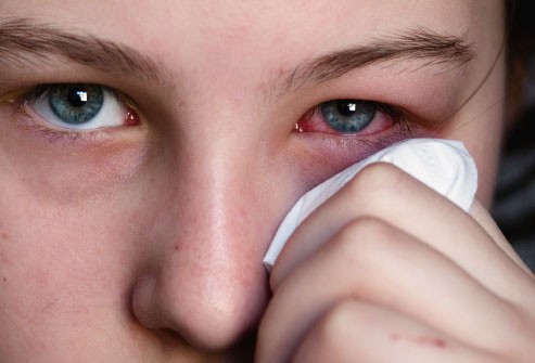 Cách chăm sóc và tránh lây nhiễm khi đau mắt đỏ