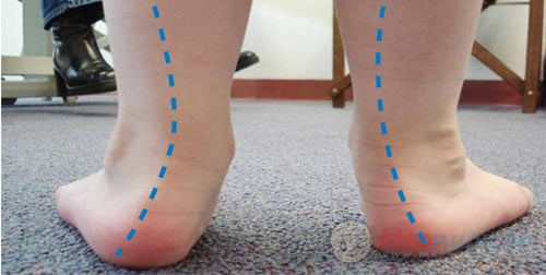 Dị tật bàn chân bẹt ở trẻ – cần kiểm tra & điều trị kịp thời - 2
