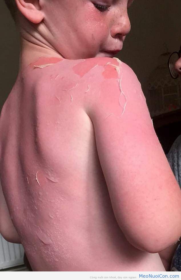 Bôi kem chống nắng để con trai ra ngoài chơi, chỉ 2 tiếng sau ông bố đã thấy con hét thất thanh chạy vào với cả tấm lưng đỏ rực vì bị bỏng - Ảnh 1.
