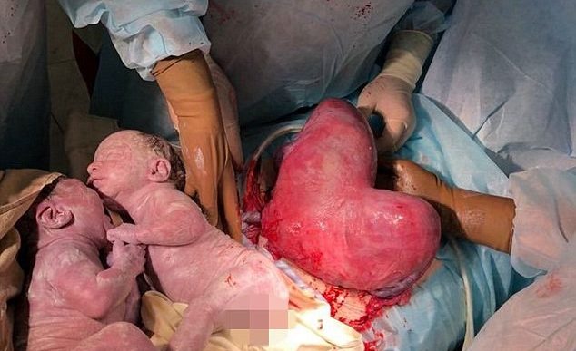 Sau khi mổ lấy thai sinh đôi, bác sĩ không tin vào mắt mình khi nhìn thấy tử cung của sản phụ