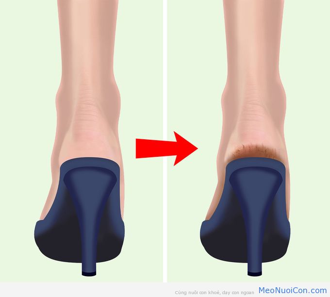 6 lý do khiến gót chân bị khô nứt