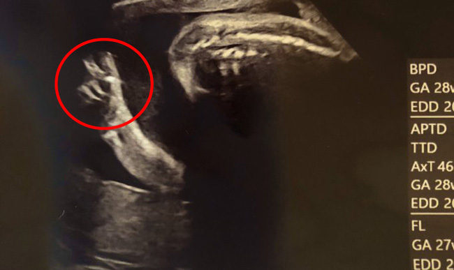Bức ảnh siêu âm chụp lại khoảnh khắc em bé giơ tay chữ V như để nói với mẹ “Mọi chuyện sẽ ổn thôi!” đốn tim hàng nghìn người