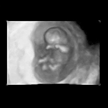 p_week103D_ultrasound.