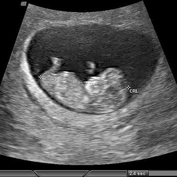 p_week10_ultrasound.