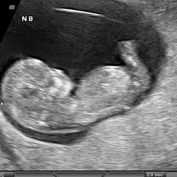 p_week11_ultrasound.