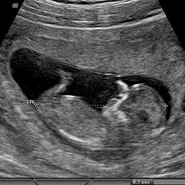 p_week12_ultrasound.