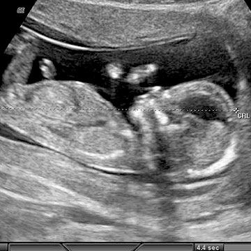 p_week13_ultrasound.