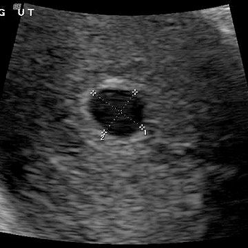 p_week4_ultrasound.