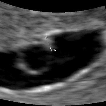 p_week5_ultrasound.