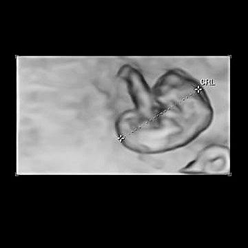 p_week6_3D_ultrasound.