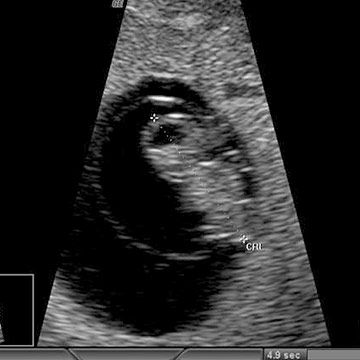 p_week7_ultrasound.