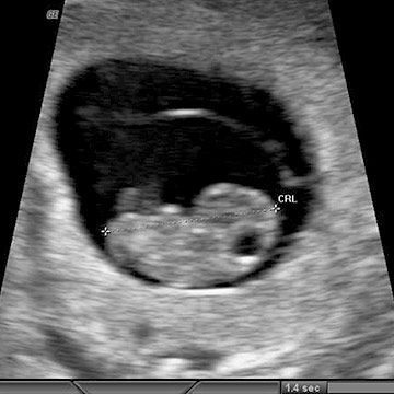 p_week8_ultrasound.