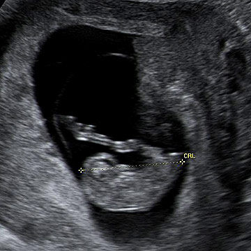 p_week9_ultrasound.