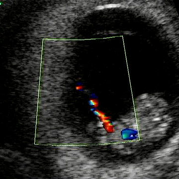 p_week9umbilicalcord_ultrasound.